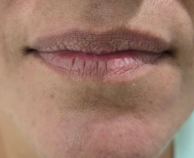 Antes — Labios, procedimiento realizado por la Dra. Aura Celeste Avalos Alfonzo